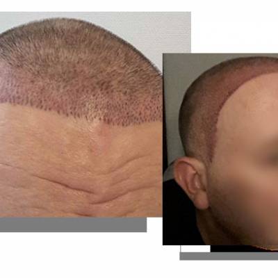tatuaż na głowie, mikropigmentacja