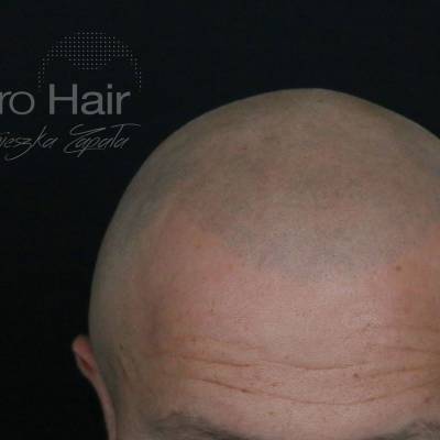 mikropigmentacja skóry głowy efekt ogolonej głowy