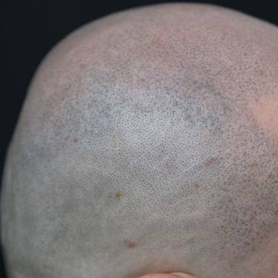 mikropigmentacja skóry głowy 