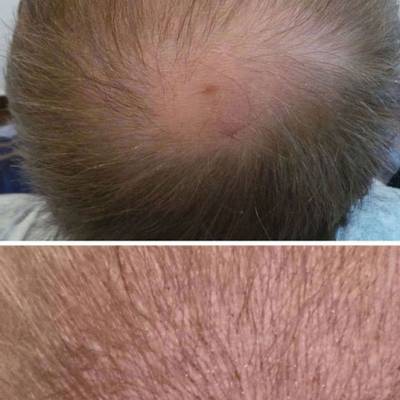 mikropigmentacja skóry głowy zagęszczanie włosów 
