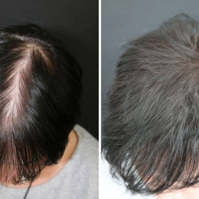 Zagęszczanie włosów mikropigmentacja skóry głowy.