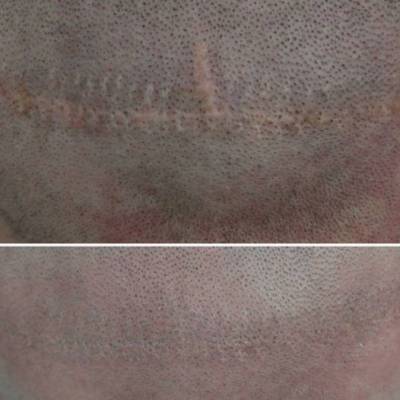 Mikropigmentacja blizny na skórze głowy